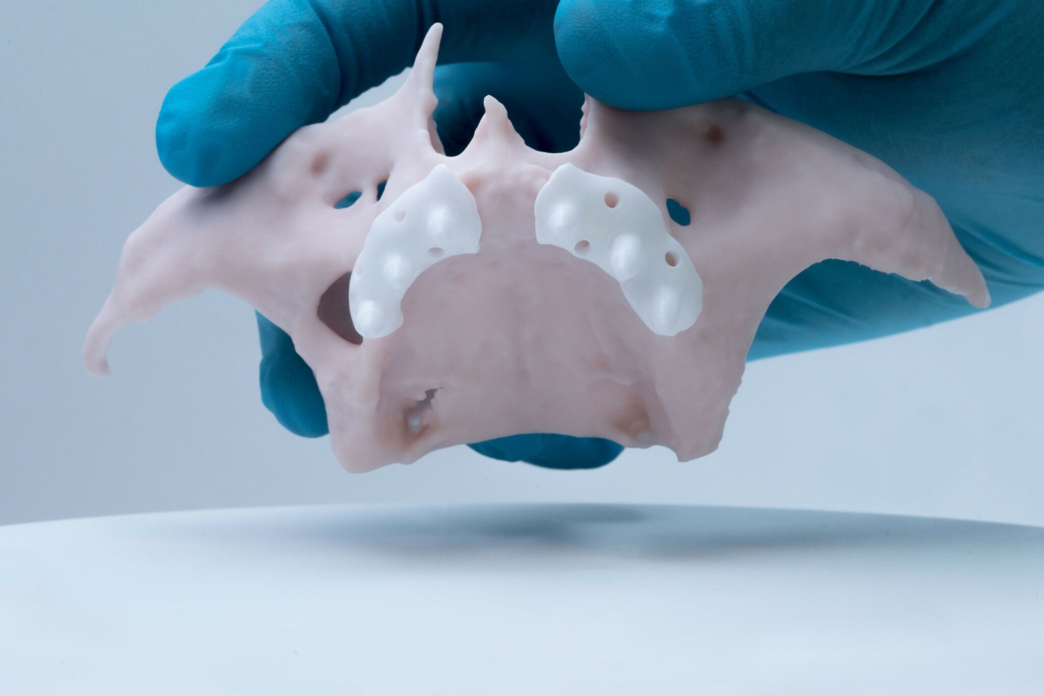Curated visual reference: Visual Reference: Ceramic Subperiosteal Jaw Implant Placed In Patient For The First